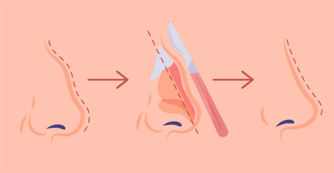 Rinoplasti Ameliyatı Tekniği ve Çeşitleri Nelerdir